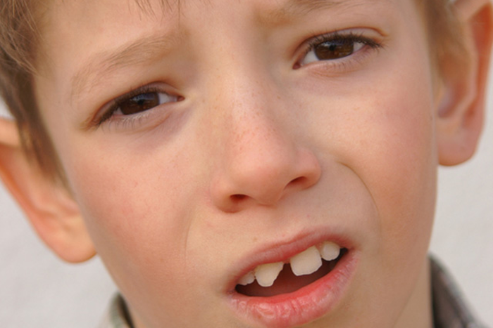 enfant avec un dent cassé